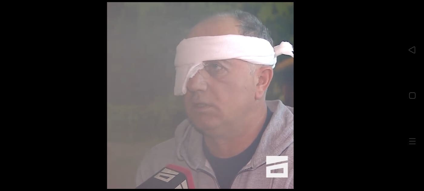 (ვიდეო) – რას ჰყვება აქციის მონაწილე, რომელსაც თვალი დაუზიანდა? – “თავად დაძაბეს…”