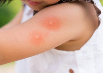 რა სახის ალერგია შეიძლება გამოიწვიოს მწერის ნაკბენმა და როგორ მოვიქცეთ? – “საზაფხულო აფთიაქი”