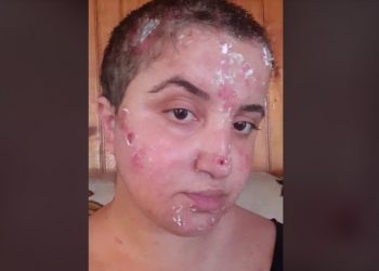 ახალგაზრდა გოგოს უიშვიათესი დაავადება აქვს, მკურნალობა კი გადაუდებელია, რადგან ყოველ დღე ჯოჯოხეთის გავლა უწევს – მადონა მერკულაძეს საზოგადოების დახმარება სჭირდება