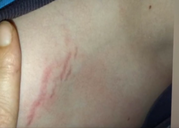 გორის მე-10 საბავშვო ბაღის დირექტორს 13 წლის მოზარდის სასტიკ ცემაში ადანაშაულებენ