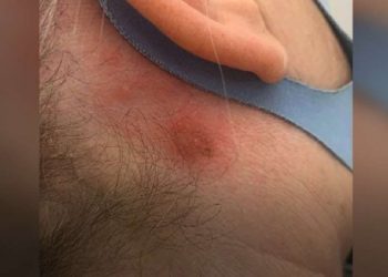 ბრიტანეთში, რამდენიმე კოვიდგადატანილ ადამიანს თმის საღებავზე ალერგიული რეაქცია განუვითარდა