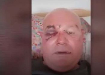 “ეჭვი გვაქვს, “კასტეტითაა” ნაცემი… – რუსთავში ენმ-ის მხარდამჭერს თავს დაესხნენ