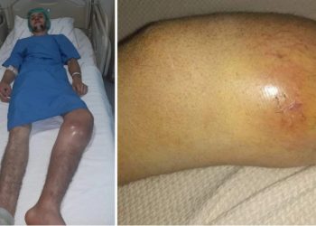 22 წლის ახალგაზრდას გიგანტური უჯრედოვანი სიმსივნის დიაგნოზი დაუსვეს, მკურნალობისთვის კი ოჯახს თანხა არ გააჩნია – რამინი ხარაბაძეს საზოგადოების დახმარება სჭირდება