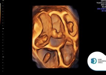 საქართველოს ერთ-ერთ კლინიკაში 5-ნაყოფიანი ორსულობა დააფიქსირეს