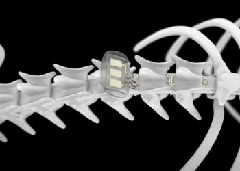 იმპლანტი, რომლითაც ხერხემლის დაზიანების შედეგად პარალიზებულმა ადამიანმა ფეხზე გაიარა – ვიდეო