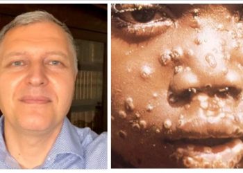 “მაიმუნის ყვავილი“ – რას წერს გიორგი ფხაკაძე ევროპაში გავრცელებულ ვირუსზე?