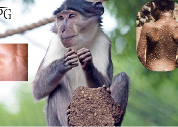 NCDC-ის განმარტება მაიმუნის ყვავილის შესახებ, რა უნდა ვიცოდეთ ამ დაავადებაზე?