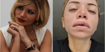 “მომატყუეს, ფილერის მაგივრად, ბიოპოლიმერი შემიყვანეს” – როგორ იქცა ეკა ყუშიტაშვილი ესთეტიკური ცენტრების მსხვერპლად