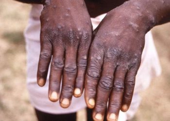 აფრიკის გარეთ “მაიმუნის ყვავილის” 780 შემთხვევა დადასტურდა