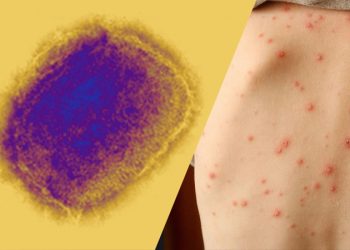 განახლებული ინფორმაცია მაიმუნის ყვავილის მიმდინარეობაზე