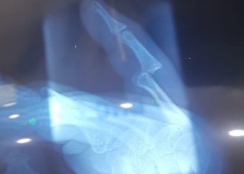 “მედალფა – ყოვლად უპასუხისმგებლო… დასვა მოტეხილობის დიაგნოზი და ამოვარდნილი თითი ბავშვს მეორე თითზე “მიუბეს” – ფოტო