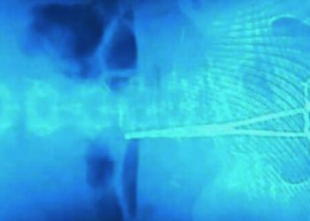 რას ამბობენ კლინიკაში, სადაც 22 წლის გოგოს ოპერაციისას მაკრატელი ჩაუტოვეს