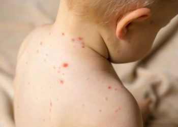 როგორ მოვუაროთ ბავშვს “ჩუტყვავილას” დროს? – ექიმ არ­ჩილ მარ­შა­ნი­ას რჩე­ვე­ბი