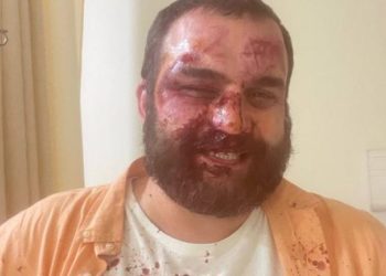 “ზონდერ-დაჯგუფებები [დამესხნენ თავს]… ეს რეჟიმის დასასრულია, ვერ შეგვაშინებენ” | დიმა ჩიქოვანი თავდასხმის შემდეგ