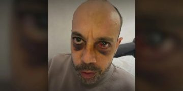 „ოთხმა ფორმიანმა სცემა, ტვინში ჰემატომა აქვს, შაბათს უტარდება ოპერაცია“ – ანტირუსულ აქციაზე ნაცემი აშშ-ის მოქალაქის მდგომარეობა მძიმეა