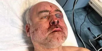 თვალბუდის ძვალი მაქვს ჩამტვრეული, ასევე დამტვრეულია ზედა ყბა, ტვინის შერყევა საკმაოდ მძიმე ფორმის და სერიოზული ჰემატომები თავზე – ქაცარავას პირველი კომენტარი