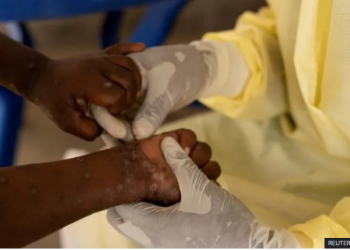 ევროპაში მაიმუნის ყვავილის პირველი შემთხვევა დაფიქსირდა