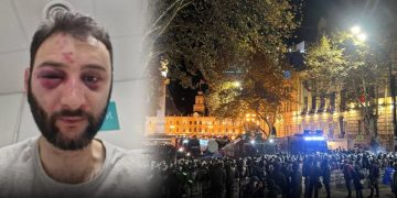 სპეცრაზმელების მიერ ნაცემ აქციის მონაწილეს თვალისა და ყბის ოპერაცია ჩაუტარდა