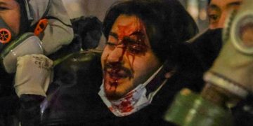 რეანიმაციაშია, უგრძელდება მედიკამენტური ძილი, სასიცოცხლო პარამეტრები სტაბილურია – ექიმი აქციაზე დაშავებულ 22 წლის ახალგაზრდაზე