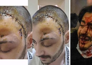 “დამნაშავე თავისუფალია. მე კი ტრავმირებული დავდივარ – თავზე ძვლის გარეშე, ტკივილით, შიშით და უპასუხოდ” – ალექსი თირქია