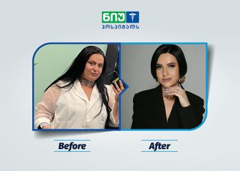 მინუს 64 კილო 1 წელში – რა დროში ჩანს ბარიატრიის პირველი შედეგი და როგორია ცხოვრება ოპერაციის შემდეგ? – ხატია ბურჯანაძე
